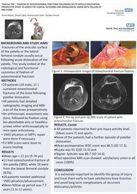 799 FIXATION OF OSTEOCHONDRAL FRACTURES FOLLOWING ACUTE PATELLA DISLOCATION1.jpg