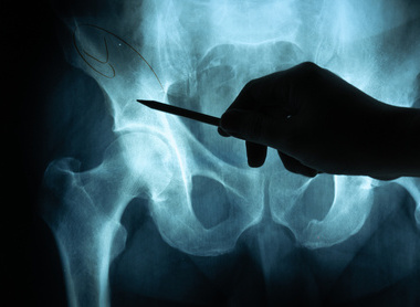 Royal Osteoporosis Society information regarding surgery for broken hips image