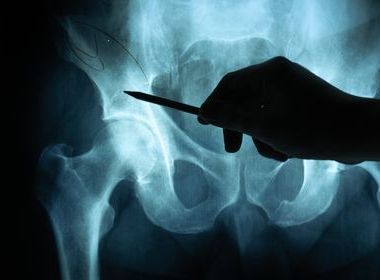 Royal Osteoporosis Society information regarding surgery for broken hips  image