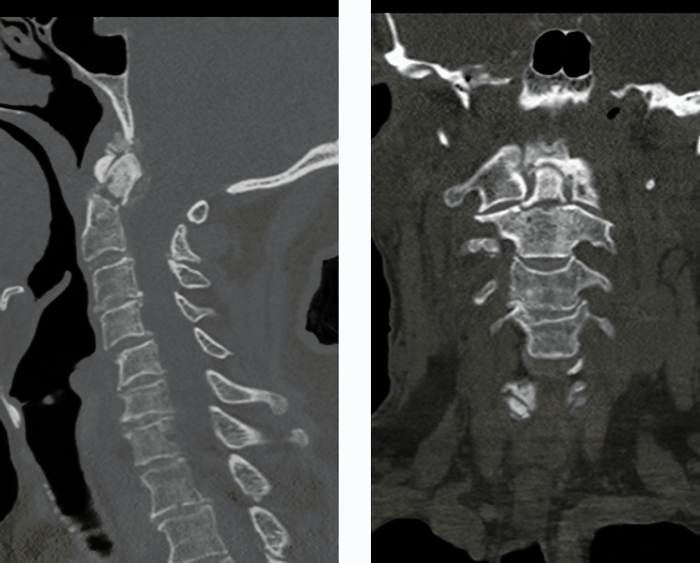 figure 2 odentoid.png