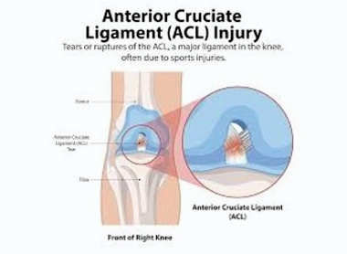 The Football Association of Wales guidance on How to Prevent ACL Injuries image
