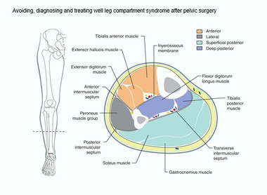 Avoiding, diagnosing and treating well leg compartment syndrome after pelvic surgery image