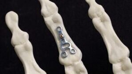 Hand Fracture Fixation.jpg