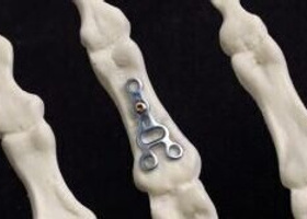 Hand Fracture Fixation.jpg