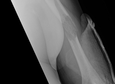 BOAST - Management of Metastatic Bone Disease image