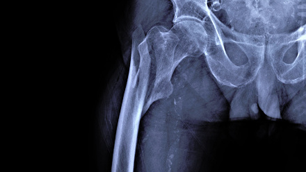 X-Ray+of+Hip+Joint+with+Femoral+Neck+Fracture,+Traumatology+and.jpg