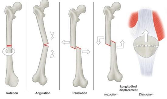 Fractures - quizlet.jpg