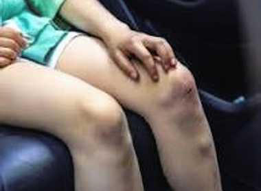 Why are so many teen girls still tearing their ACLs? image