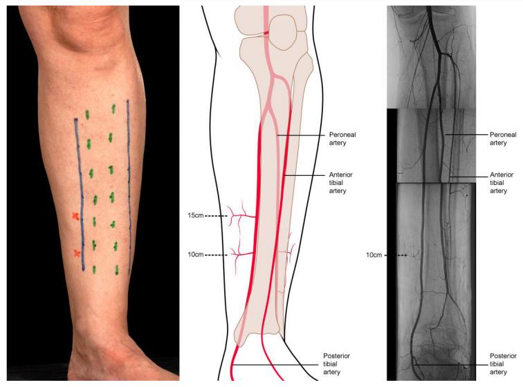 BOAST Open Fractures 1.png